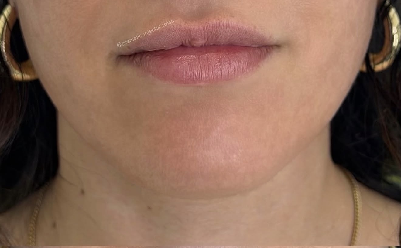 Lip Filler before