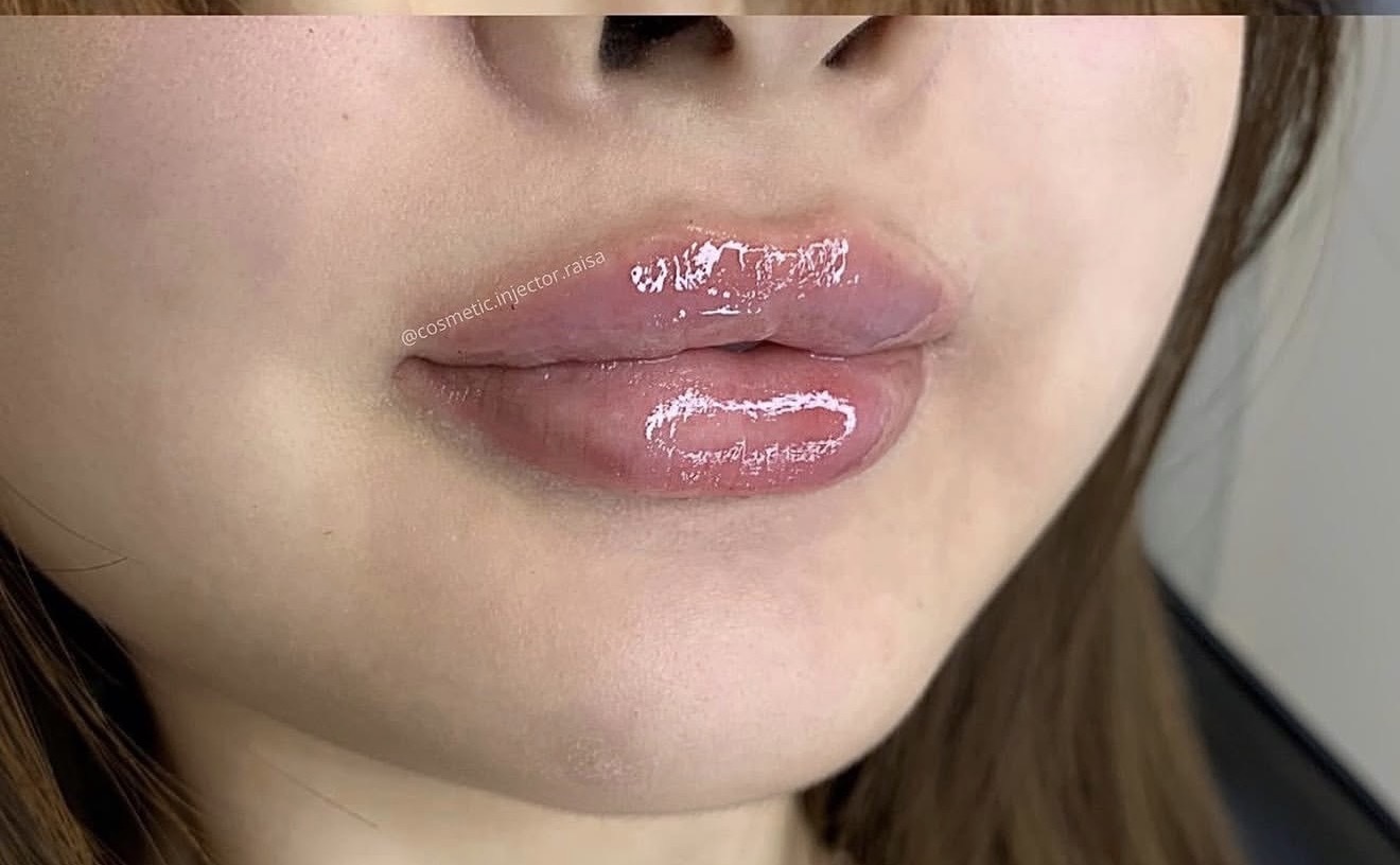 Lip Filler after