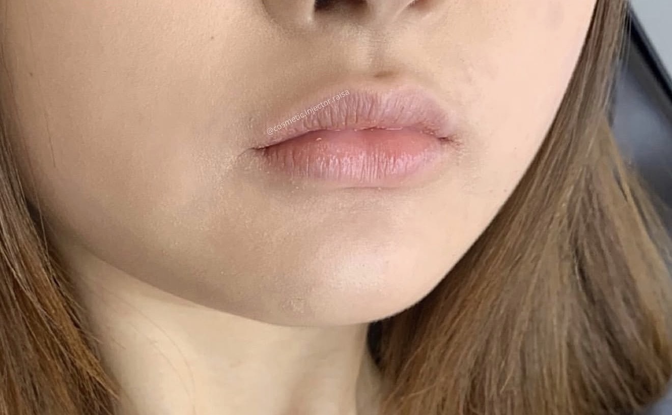 Lip Filler before