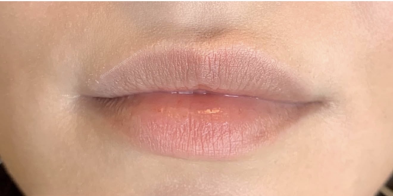 Lip Filler before