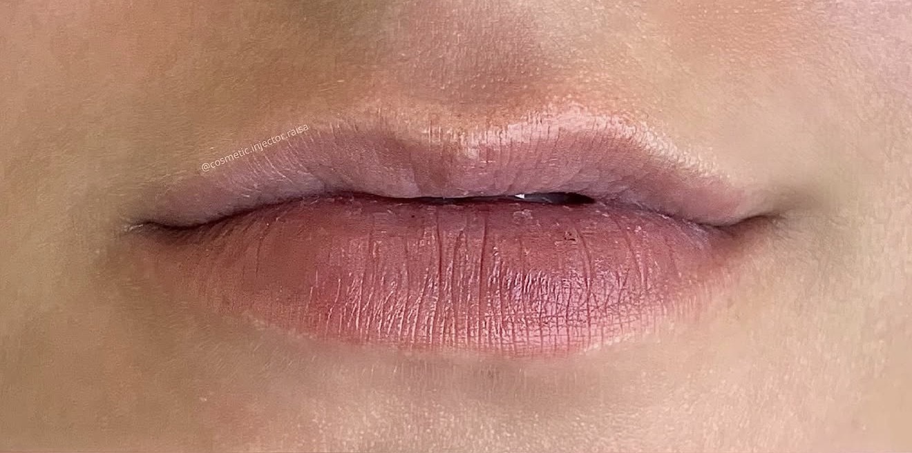 Lip Filler before