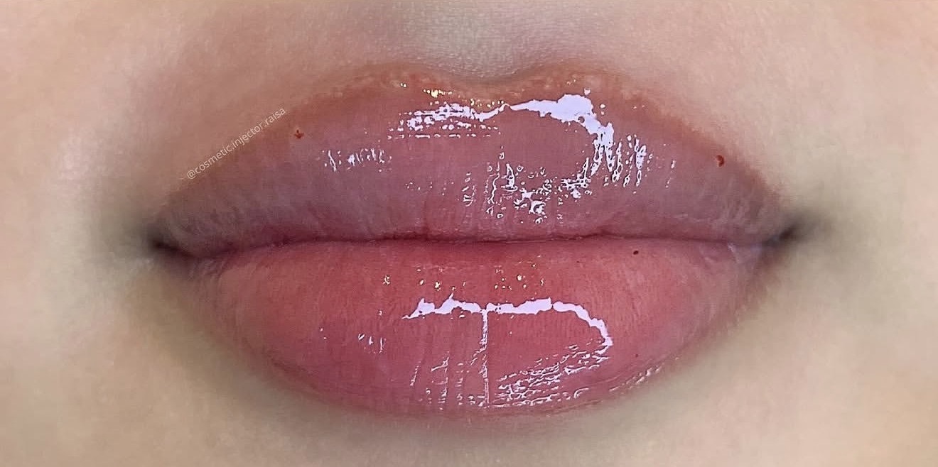Lip Filler after