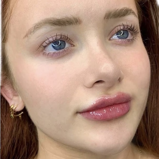 Lip Filler after