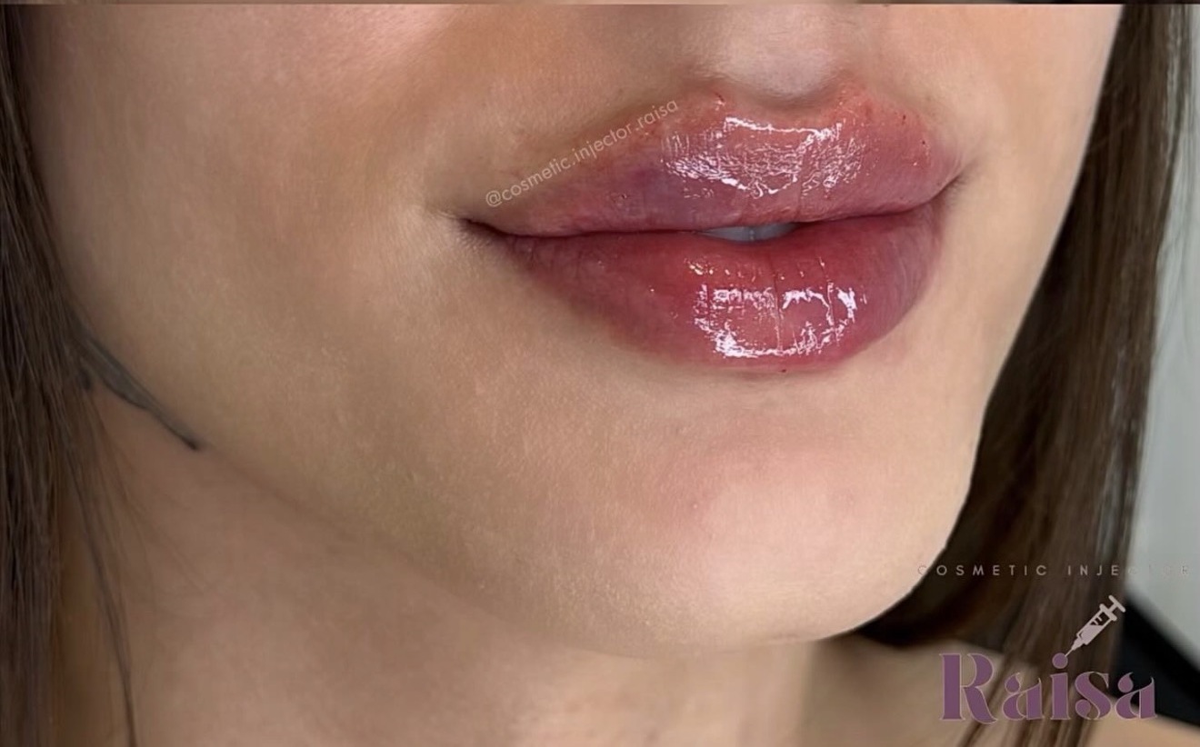 Lip Filler after