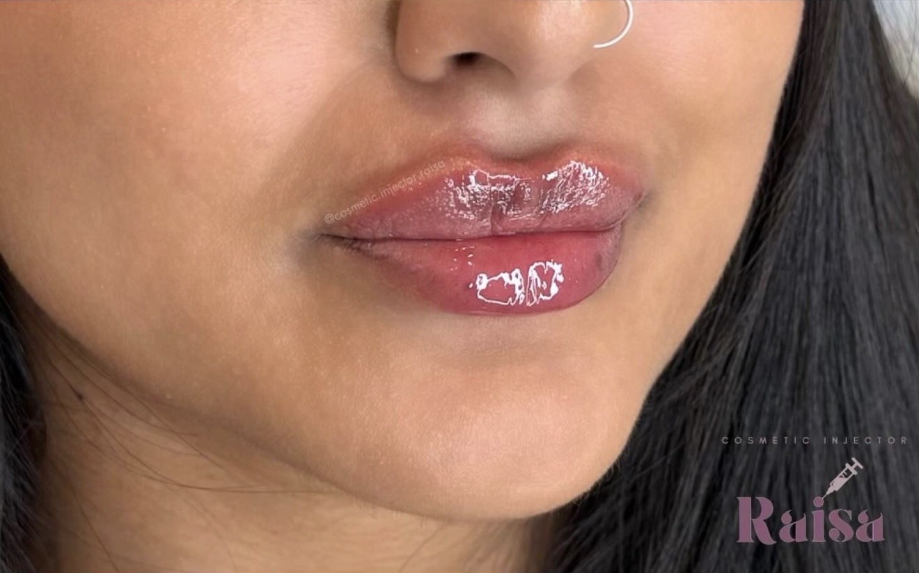 Lip Filler after