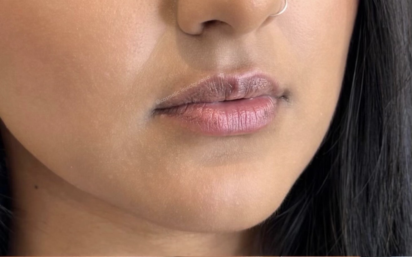 Lip Filler before