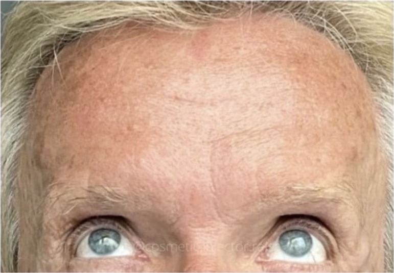 Botox after