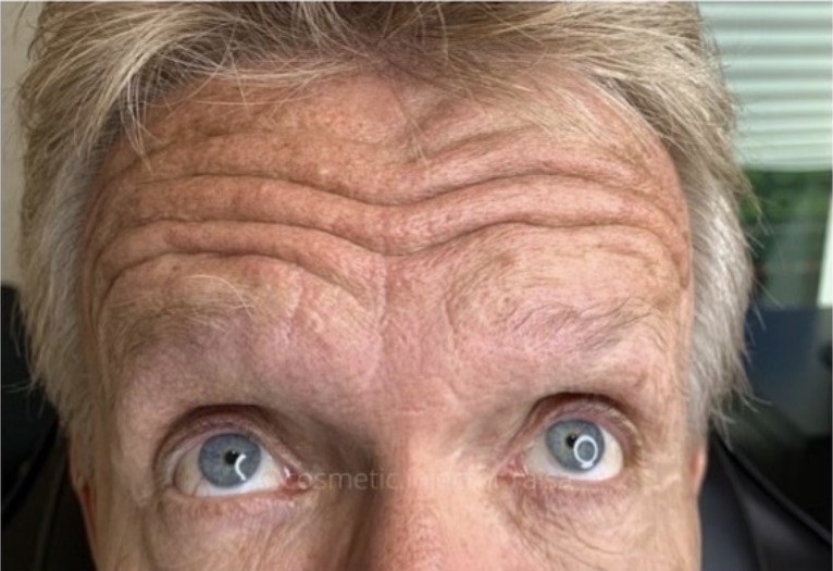 Botox before