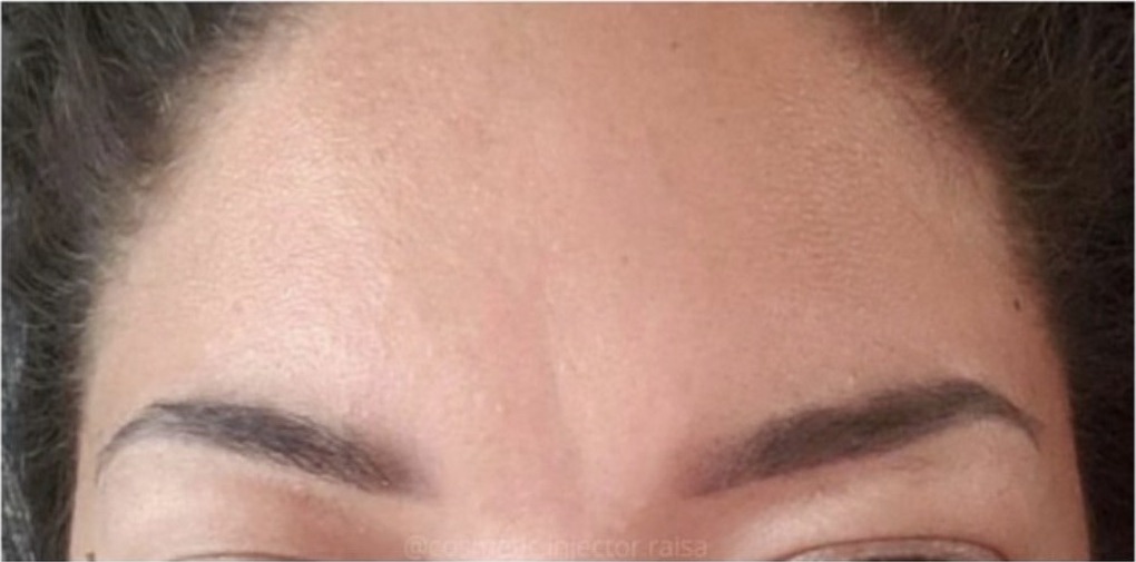 Botox after