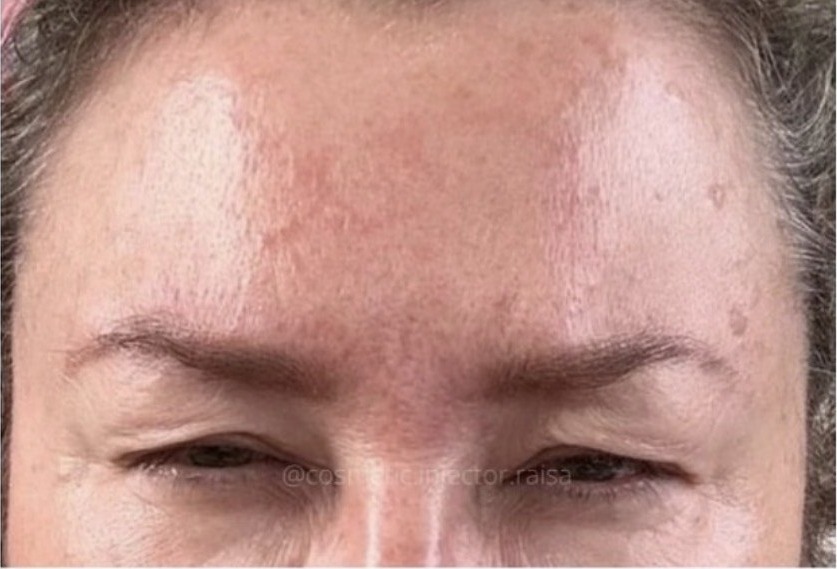 Botox after