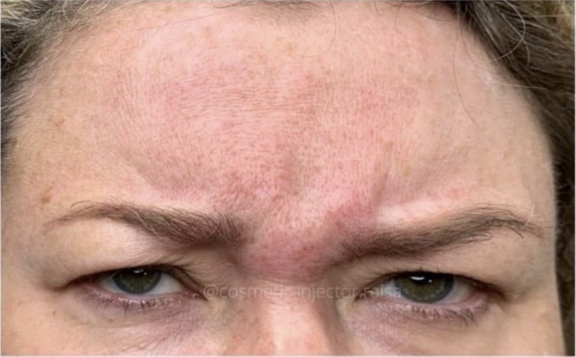 Botox before