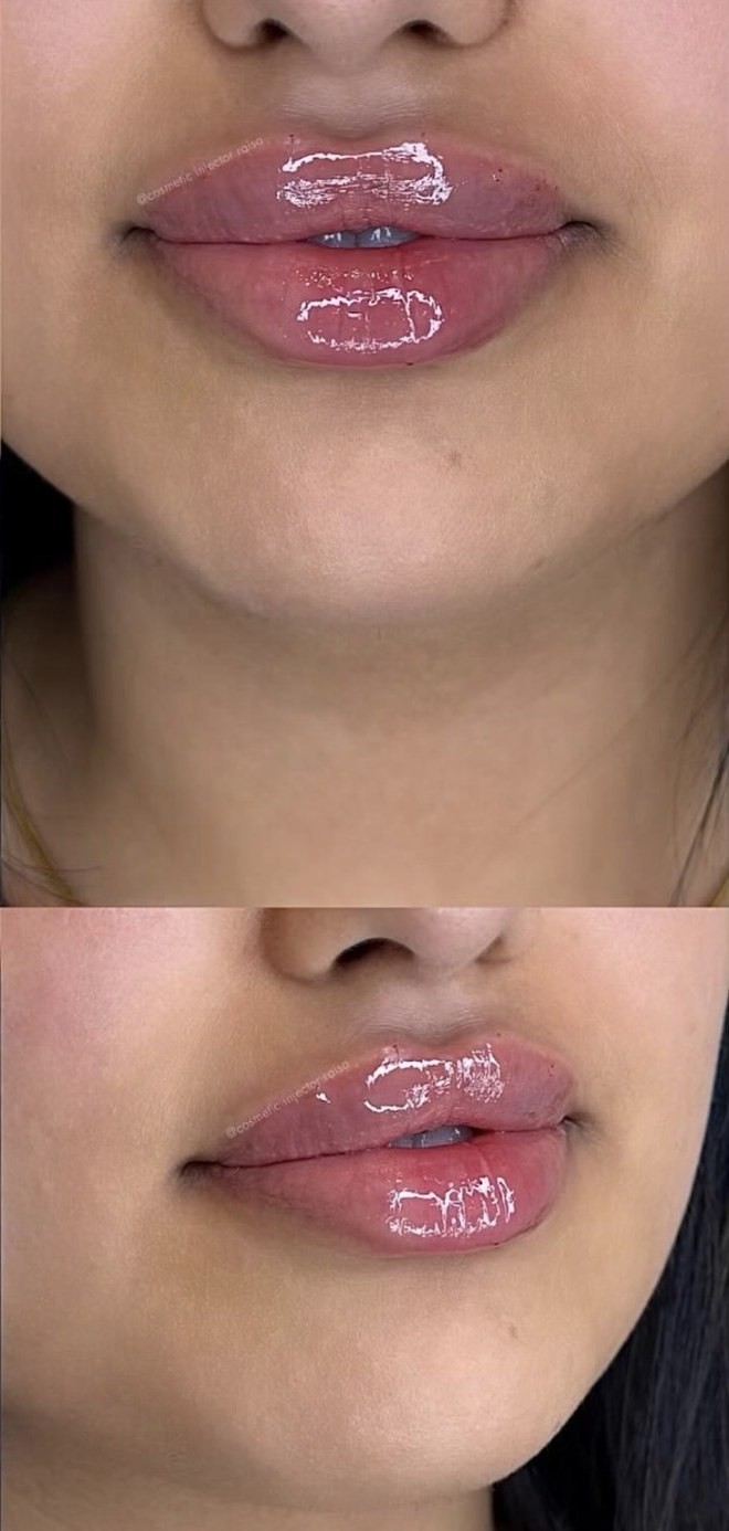 Lip Filler after
