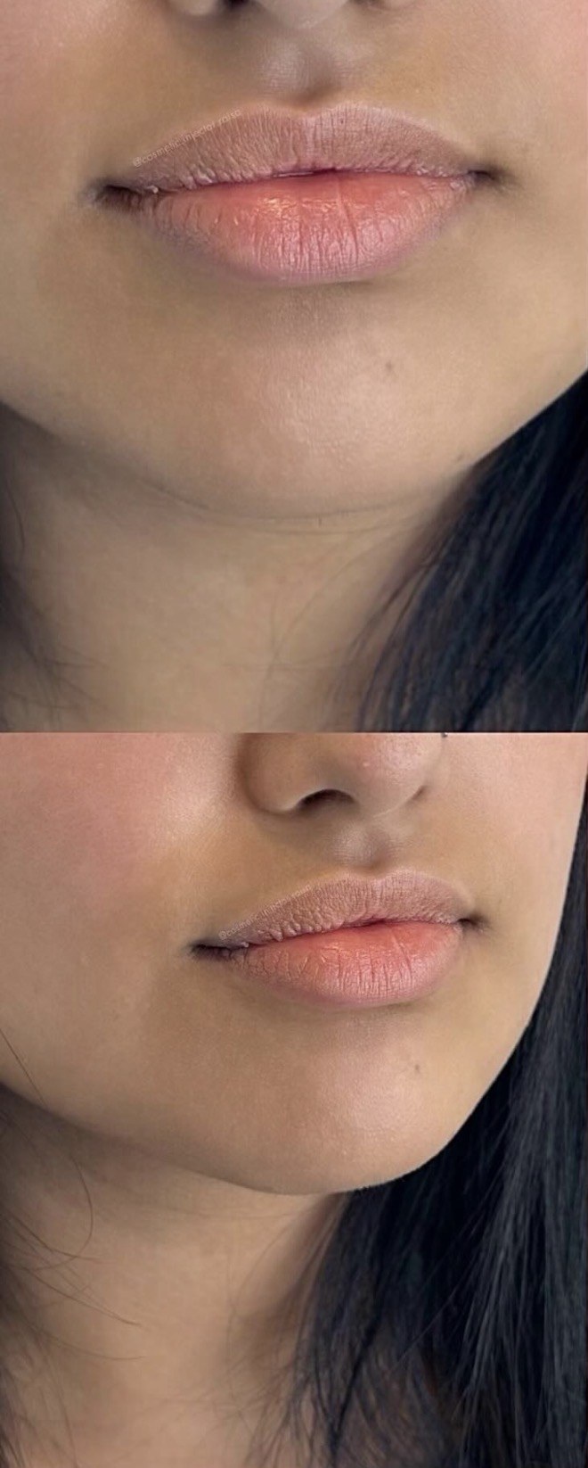Lip Filler before