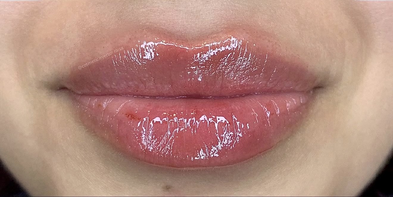 Lip Filler after
