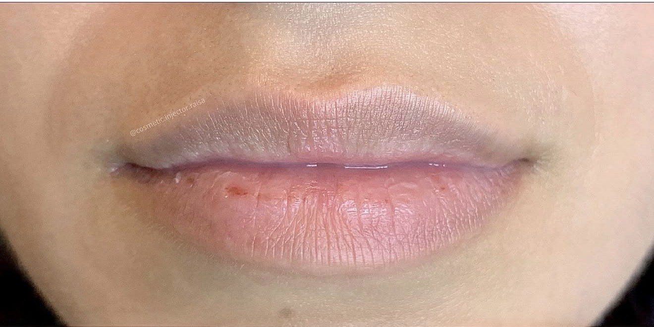 Lip Filler before