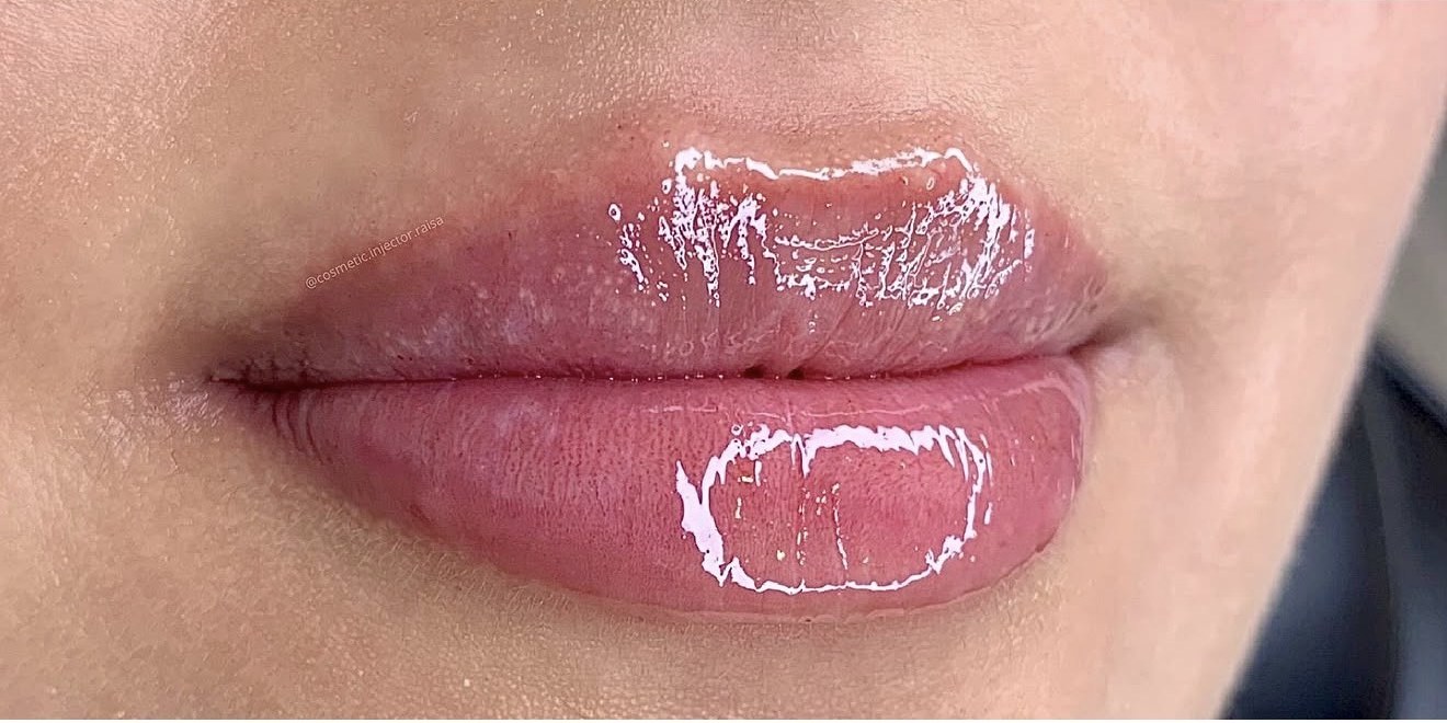 Lip Filler after