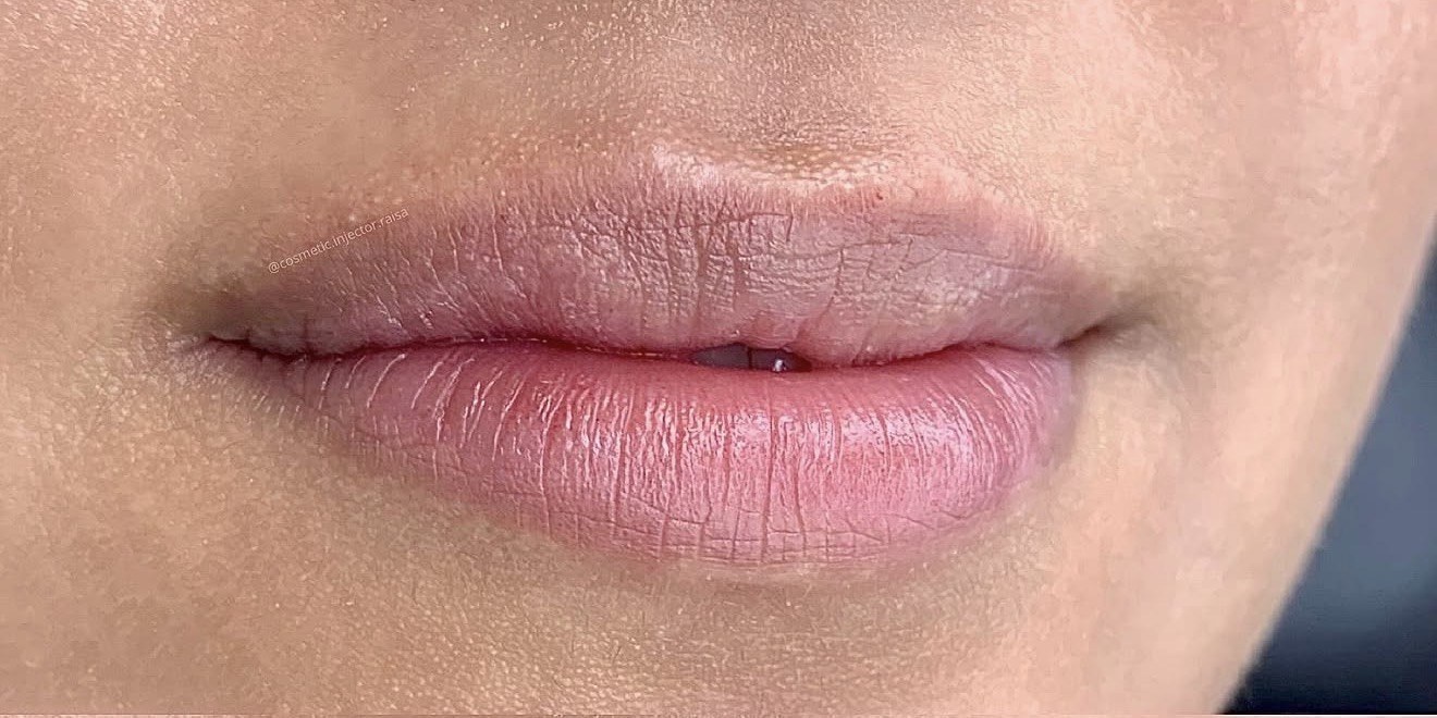 Lip Filler before