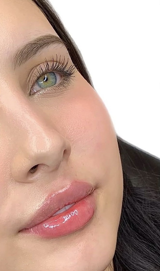 Lip Filler after