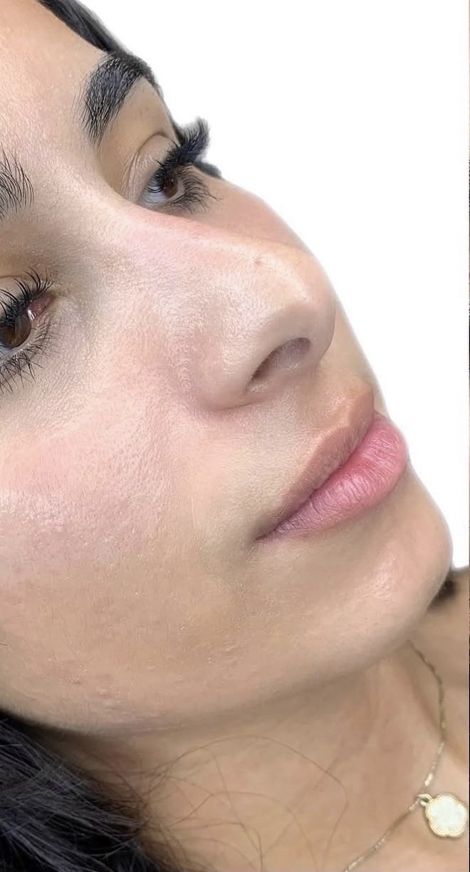 Lip Filler before